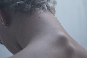 What is Cervical Disc Degeneration